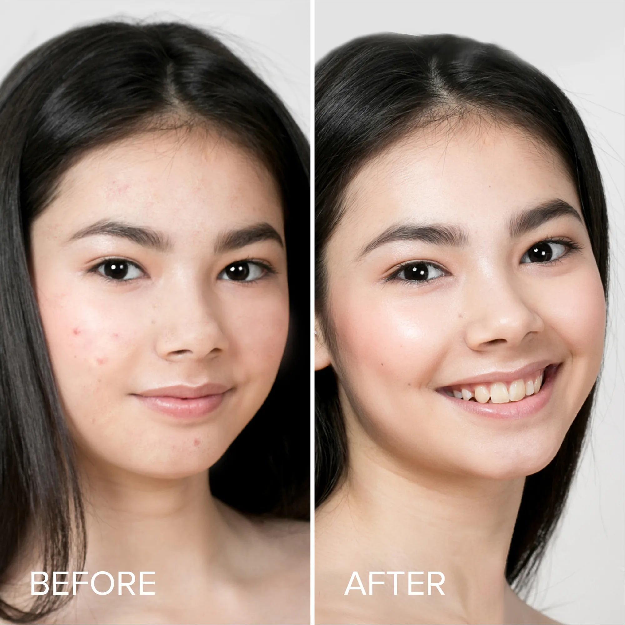 Cute Star Pimple & Acne Patches